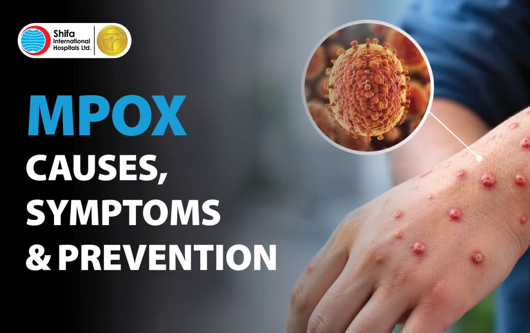 Monkey Pox: All You Need To Know