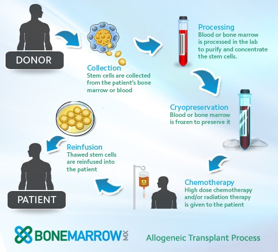 Types Of Bone Marrow Transplant Shifa International Hospital
